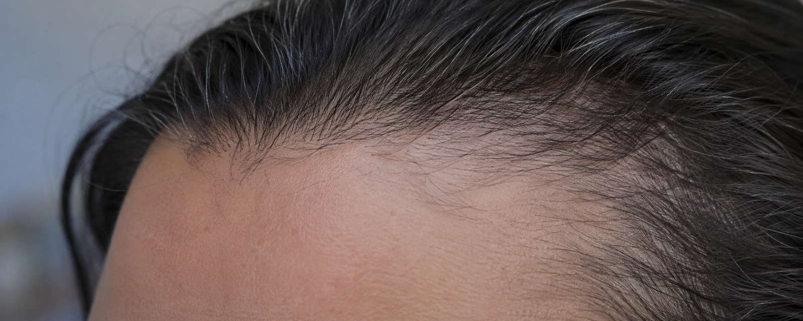 Why dermatologists tell people with FFA to avoid titanium dioxide