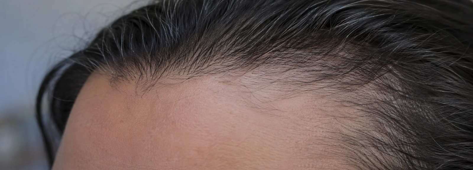 Why dermatologists tell people with FFA to avoid titanium dioxide
